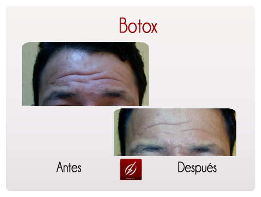botox1